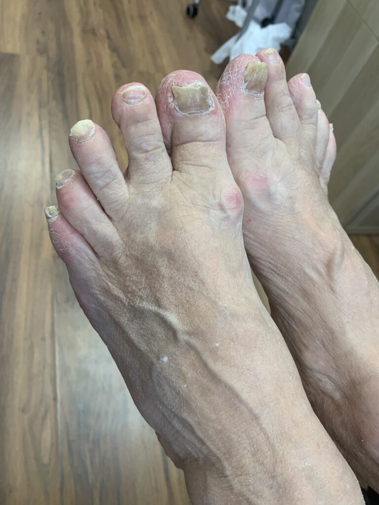 Pildil on 11 Abi Tervisekabinetis tehtud pilt mis on tehtud probleemsete jalgade hooldus.Pildil on näha vanema inimese jalad kellel on küüneseen. Küüned on muutunud ja kollased, paksud.